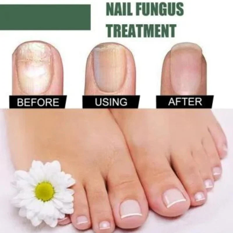 Fast Nail Fungus Treatment Serum | Nail Repair Essence for Fingernails & Toenails | Natural Nail Care Formula