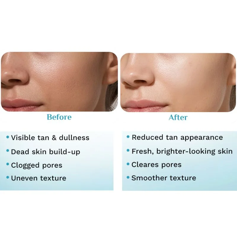 Pilgrim Peeling Solution | Weekend Facial Peel for Deep Cleansing & Exfoliation | Radiant & Even-Toned Skin | For Men & Women | 30ml thumbnail 7
